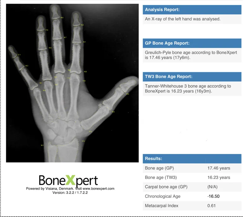 x-ray photo of a left hand.